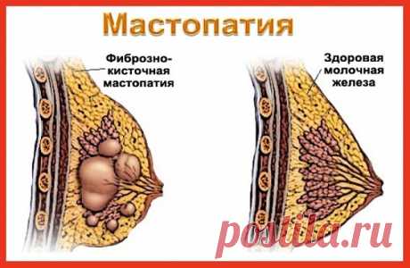 лечение мастопатии народными средствами