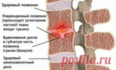 Грыжа Шморля: симптомы, местоположение, виды, лечение
Здоровая спина — залог хорошего самочувствия в любом возрасте. Болезненные ощущения могут быть как источником ощутимого дискомфорта, так сигналом серьезных заболеваний. Одно из вероятных — грыжа Шморля.