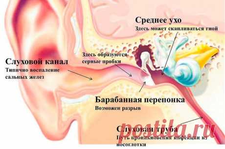 Как избавиться от серной пробки в домашних условиях...