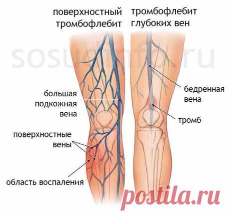 Симптомы тромба, которые вы не должны игнорировать - Журнал Советов Страх узнать о какой-либо аномалии может быть интенсивным. Не только наше физическое здоровье необходимо для ежедневной работы, но и психическое, эмоциональное и духовное благополучие позволяет нам быть счастливыми. Плохая новость после обнаружения потенциального состояния очевидна – есть проблема. Хорошая новость, касающаяся тромбов – способность распознавать ранние признаки сгустка крови. Вот список осно...
