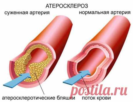 СНИЖЕНИЕ ХОЛЕСТЕРИНА НАРОДНЫМИ СРЕДСТВАМИ