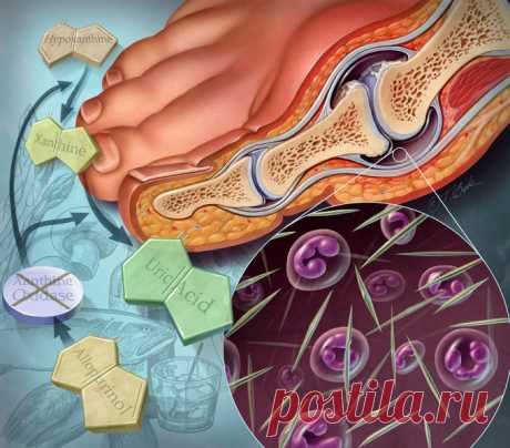 Окаменеть заживо: Подагрический артрит