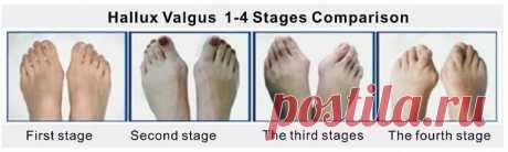 Причины роста косточки на ноге и методы лечения шишки на большом пальце ноги