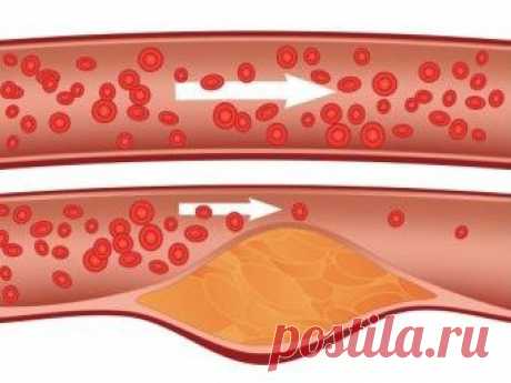 Снижаем холестерин народными средствами