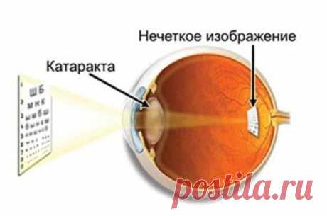 Катаракта. Лечение народными средствами. | Мамам, женщинам, бабушкам и очень любознательным.