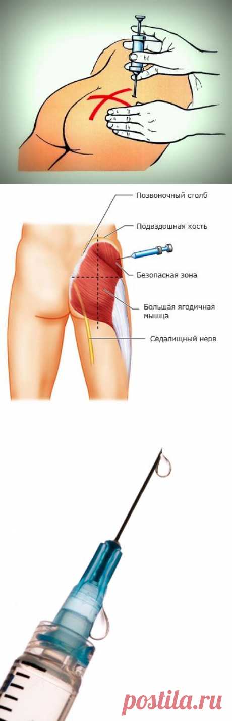 Внутримышечная инъекция в ягодицу: учимся делать самостоятельно — Делимся советами