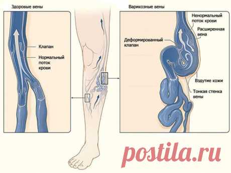 8 упражнений против варикоза — Бабушкины секреты