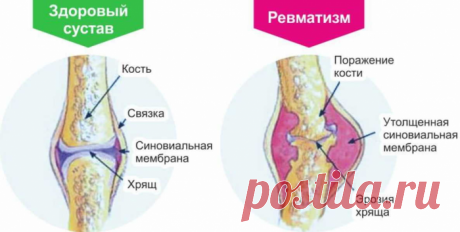 Лечение ревматизма народными методами: спасительные травы придут на помощь