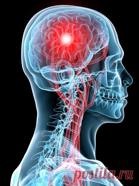 Первая помощь при инсульте. О чем важно знать Эти признаки инсульта должны насторожить любого человека! Они являются показанием для незамедлительного вызова бригады скорой медицинской помощи. Вот, что вы можете сделать до приезда медиков.