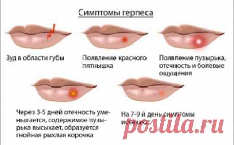 7 НАРОДНЫХ МЕТОДОВ, КОТОРЫЕ ПОМОГУТ ТЕБЕ ИЗБАВИТЬСЯ ОТ ГЕРПЕСА В ТЕЧЕНИЕ ДНЯ!