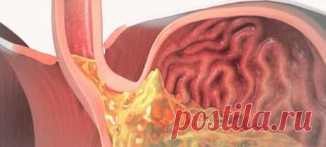 Гастроэзофагеальный рефлюкс: вылечить просто - Интернет ежедневник - медиаплатформа МирТесен