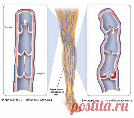 ПОДРОБНО О ВАРИКОЗНОМ РАСШИРЕНИИ ВЕН...