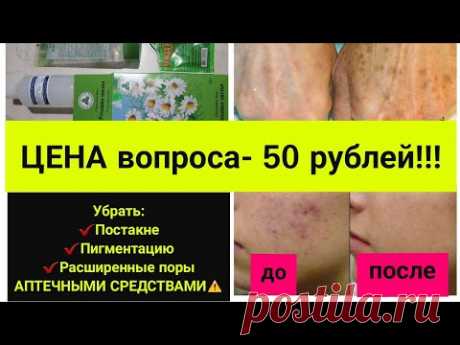 Убрать пигментные пятна, постакне, расширенные поры за 50 рублей/ Альтернатива лазерной шлифовке