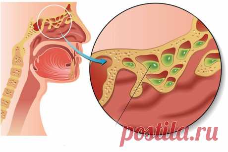 Это то, как вы можете вылечить синусовую инфекцию всего за 30 секунд! - Счастливые заметки Хороший способ! Если вы часто страдаете синусовыми инфекциями, то у нас есть отличная новость для вас, это средство быстро устранит любые ваши симптомы. Давайте посмотрим, как освободить ваш синус: Назальные проходы содержат давление, которое движется вперед и назад. Это давление позволяет ослабить мокроту в синусе. Здесь начинается дренаж. Вы должны надавить языком на верхнее небо […]
