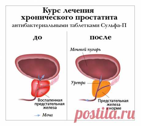 Қалай тез созылмалы простатит емдеуге