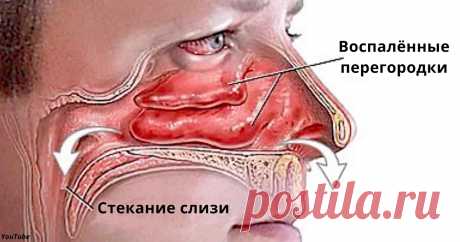 Вот как за пару минут избавиться от насморка Легко, просто и бесплатно!...