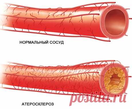 Самые эффективные методы лечения атеросклероза