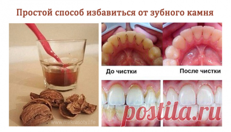 Как избавиться от зубного камня без посещения стоматолога?