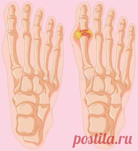 Что нужно знать о подагре / Будьте здоровы