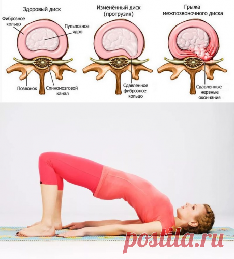 Упражнения, которые выручат при протрузии межпозвоночного диска