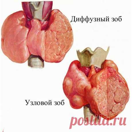 Диффузный зоб - симптомы, причины, степени и лечение диффузного зоба