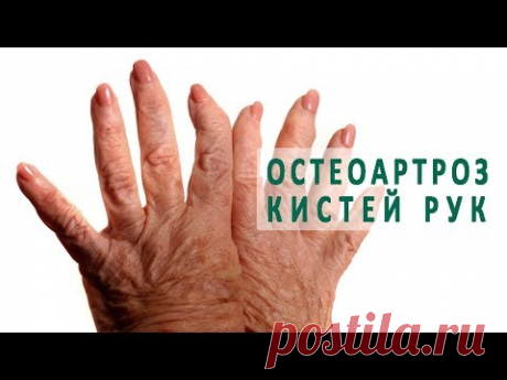 Остеоартроз кистей рук