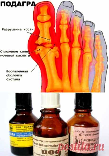 (+1) - Домашнее лечение подагры | ВСЕГДА В ФОРМЕ!