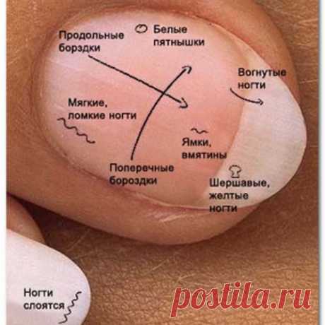 ЧТО ОЗНАЧАЮТ &quot;МЕТКИ&quot; НА НОГТЯХ