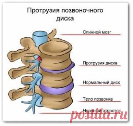 Протрузии позвоночника - доктор Бубновский