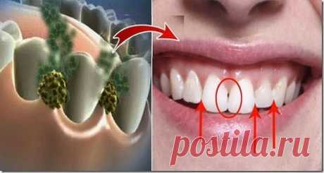 Избавьтесь от неприятного запаха изо рта за 5 минут! Супер средство, которое уничтожит все бактерии во рту!