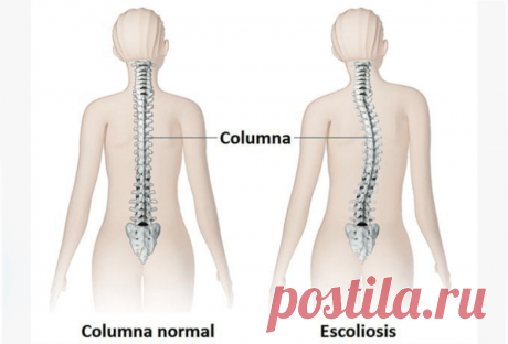 Простые упражнения для коррекции сколиоза / Будьте здоровы