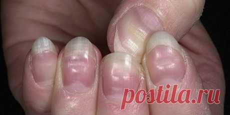 Как определить состояние здоровья по ногтям (11 признаков) | Болтай