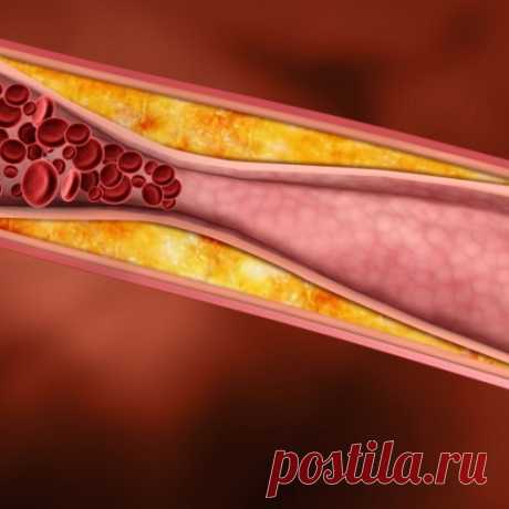 Как понизить холестерин без лекарств и очистить сосуды