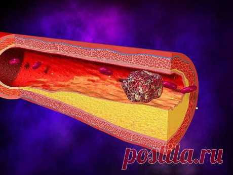 ТРОМБЫ... **Это касается каждого !!! *Инфаркт, инсульт, тромбофлебит, варикозное расширение вен, геморрой… Что общего у всех этих заболеваний? Одна из причин их возникновения — густая кровь, и надо разжижать. Можно обойтись без дорогих препаратов, просто изменив свой рацион! Запомните несколько простых советов...