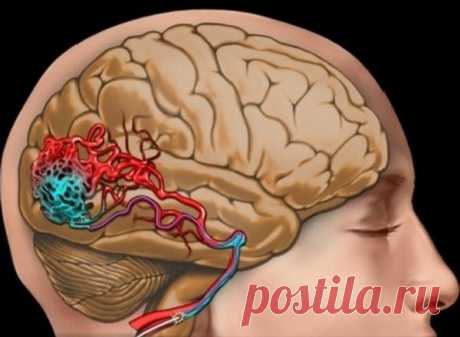 Причины, симптомы и лечение сужения сосудов головного мозга / Будьте здоровы