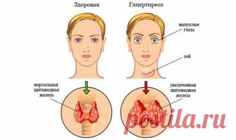 Лечение щитовидной железы народными средствами