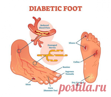 Диабетическая стопа: симптомы и лечение, стадии, уход за ногами