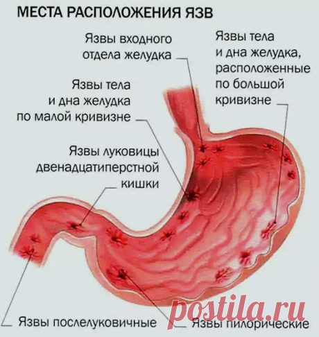 Диета после операции прободной язвы желудка | Bolzheludka.ru