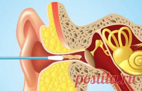 Врачи умоляют людей не засовывать ватные палочки во внутрь своих ушей! Причина может Вас удивить…