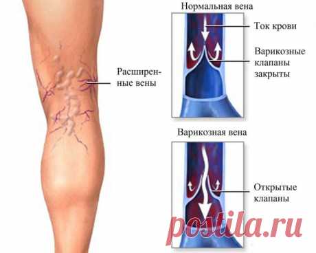 Варикоз на ногах — диагностика, лечение и профилактика