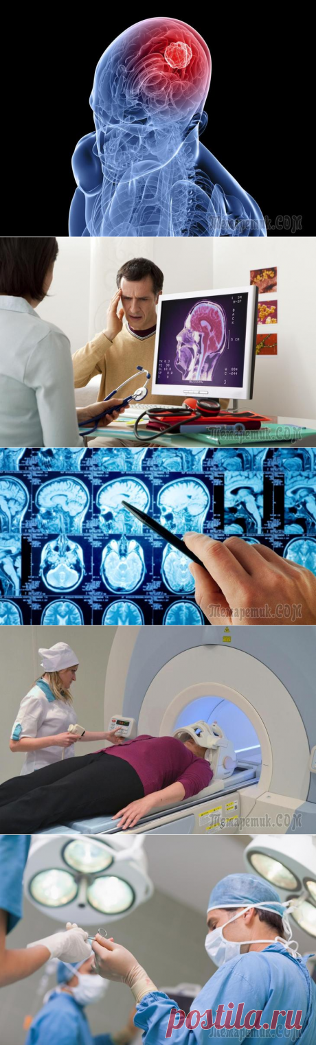 Рак мозга – симптомы, признаки, стадии, диагностика и лечение