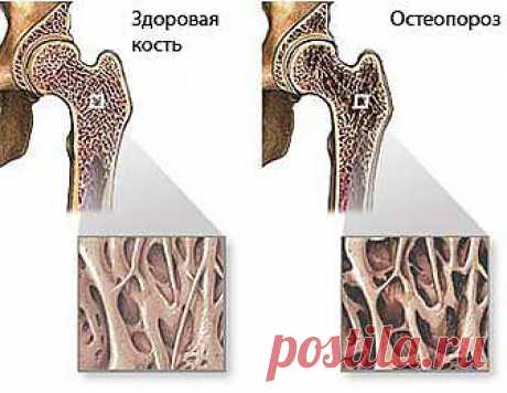 Остеопороз. Народные рецепты лечения остеопороза.