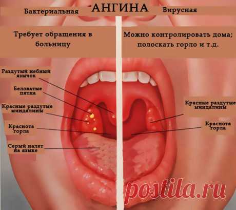 Как_лечить_ангину_эффективные_методы_восточной_медицины Народная медицина — рецепты, советы, способы, cекреты и народные средства.