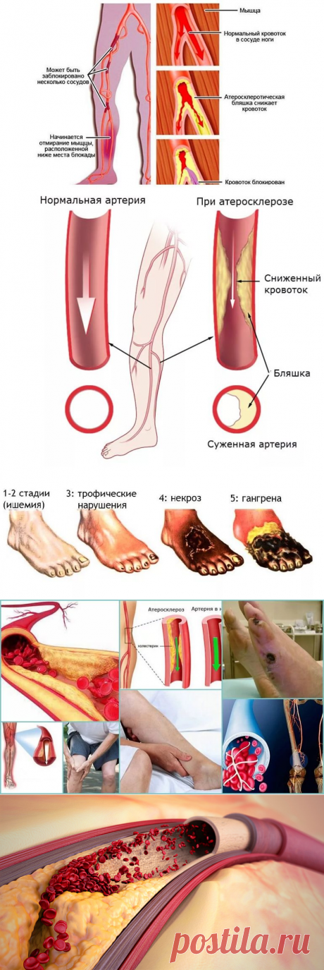 Облитерирующий атеросклероз сосудов нижних конечностей: когда ставится диагноз, медикаментозное лечение