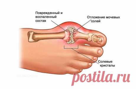 Как вывести лишнюю мочевую кислоту из организма?