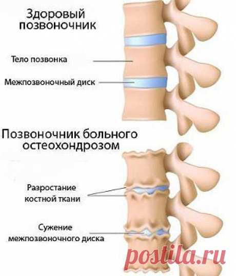 ЛФК при шейном остеохондрозе