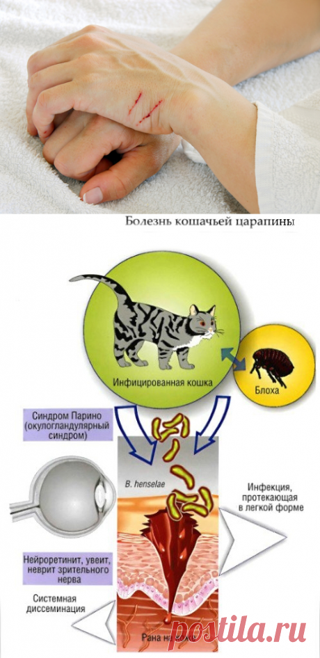 Фелиноз – болезнь кошачьих царапин