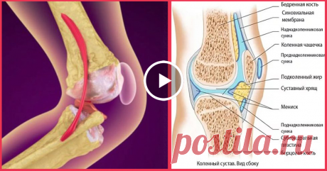 Вылечи колени и восстанови кости и суставы с этим рецептом
