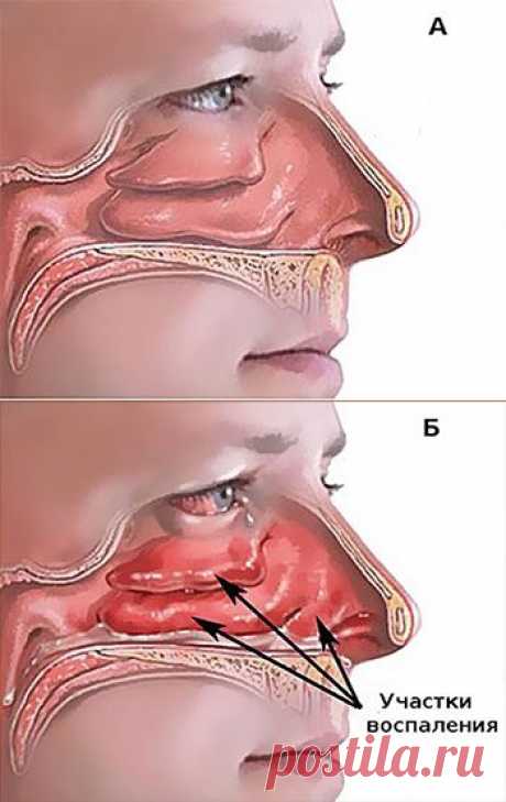 Лечение ринита методами народной медицины / Будьте здоровы