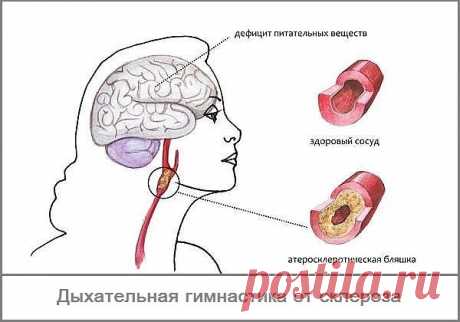 Дыхание от склероза - дыхательная гимнастика Л.А.Анисимова.